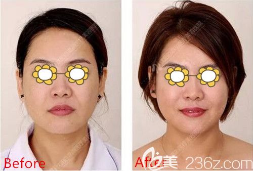 面部線雕+玻尿酸填充塑形術(shù)前術(shù)后對(duì)比 面部線雕+玻尿酸填充塑形術(shù)前術(shù)后對(duì)比