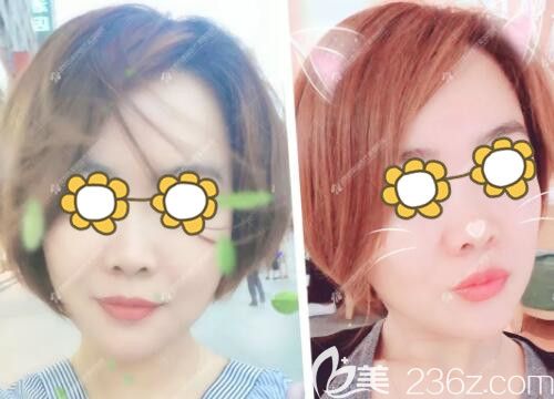 沈陽(yáng)百嘉麗玻尿酸填充怎么樣？用我做面部線雕+玻尿酸填充塑形的真實(shí)案例效果告訴你答案！