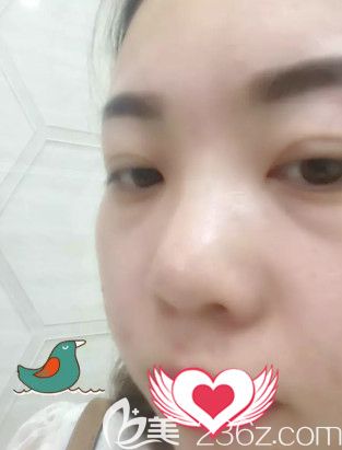 在<!--<i data=20240703-sp></i>-->整形美容醫(yī)院刷果酸第15天擺脫肌膚暗沉 在<!--<i data=20240703-sp></i>-->整形美容醫(yī)院刷果酸第15天擺脫肌膚暗沉