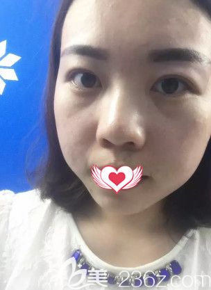 <!--<i data=20240703-sp></i>-->整形美容醫(yī)院刷果酸第3天黑頭減少 <!--<i data=20240703-sp></i>-->整形美容醫(yī)院刷果酸第3天黑頭減少