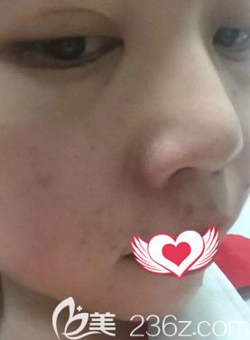 楊莎莎醫(yī)生剛為我做完果酸換膚皮膚明顯改善 楊莎莎醫(yī)生剛為我做完果酸換膚皮膚明顯改善