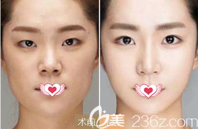 吳長國醫(yī)生做隆鼻手術(shù)案例