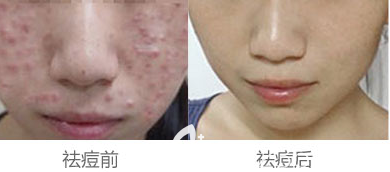北京華韓陳敏醫(yī)生祛痘美膚案例