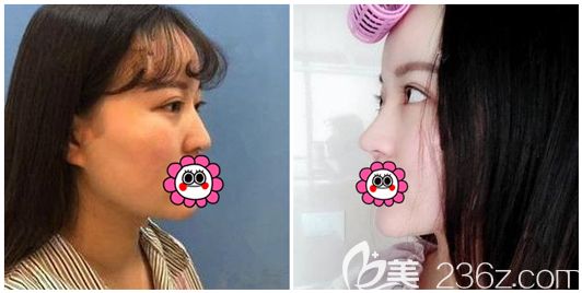 周國(guó)偉主任假體隆鼻術(shù)后效果對(duì)比