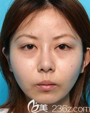 在日本美真美容做雙眼皮修復(fù)前正面照片 在日本美真美容做雙眼皮修復(fù)前正面照片