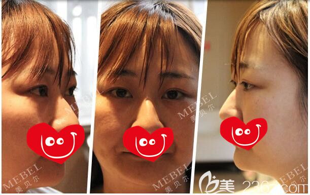 面診南京美貝爾術(shù)前雙眼皮形態(tài)不好看 面診南京美貝爾術(shù)前雙眼皮形態(tài)不好看