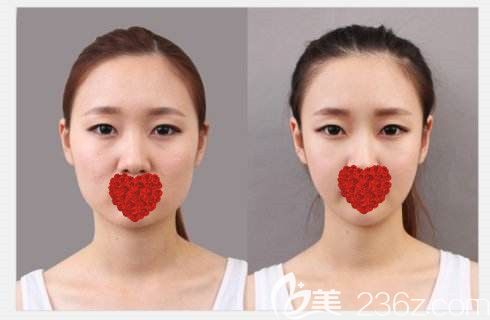 西寧時光瘦臉效果對比圖