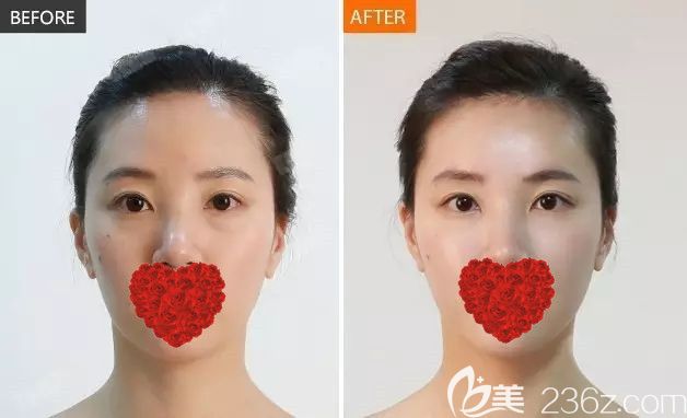 注射后皮膚變得白皙有光澤