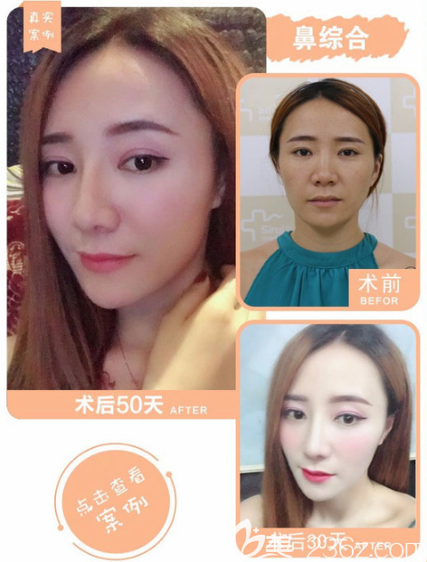 汕頭華美田學(xué)勤做的隆鼻案例效果圖 汕頭華美田學(xué)勤做的隆鼻案例效果圖