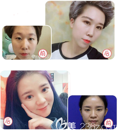 汕頭華美整形醫(yī)院田學(xué)勤雙眼皮案例 汕頭華美整形醫(yī)院田學(xué)勤雙眼皮案例