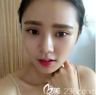 去汕頭華美做完雙眼皮10天自拍