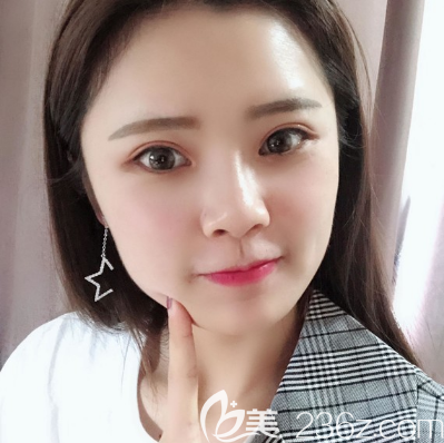 看汕頭華美田學(xué)勤做的雙眼皮好不好看