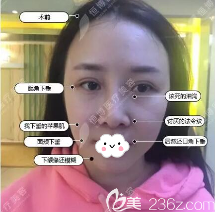 做線雕治療前的素顏照片 做線雕治療前的素顏照片