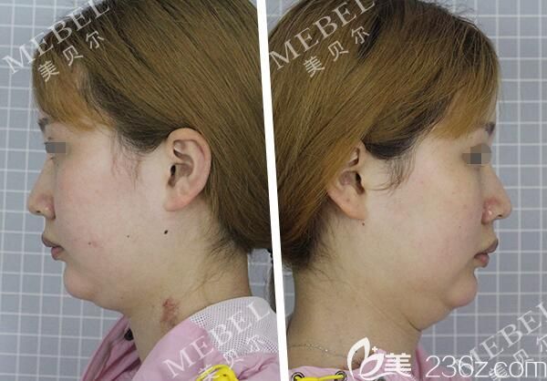 面診南京美貝爾術(shù)前嬰兒肥雙下巴 面診南京美貝爾術(shù)前嬰兒肥雙下巴