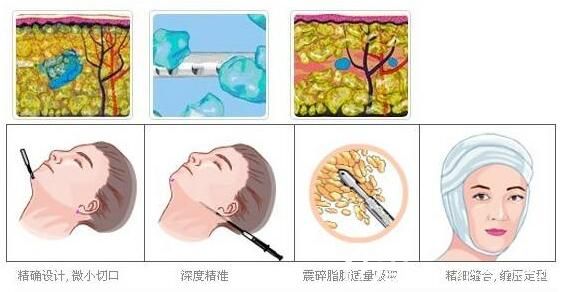 面部吸脂手術(shù)原理 面部吸脂手術(shù)原理