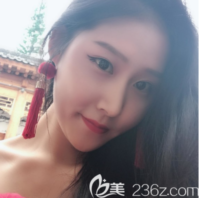 中信惠州醫(yī)院整形科雙眼皮隆鼻25天效果圖