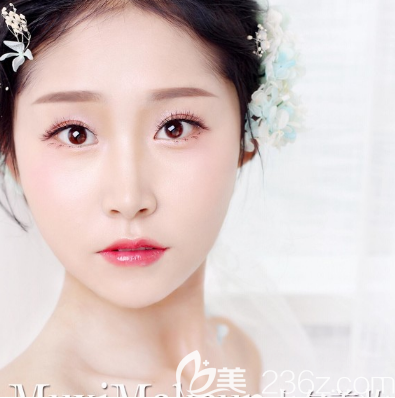 中信惠州醫(yī)院整形科陳虹雙眼皮隆鼻案例