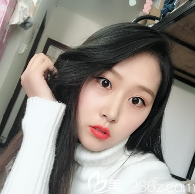 看完我找陳虹做的雙眼皮隆鼻效果再決定要不要去中信惠州醫(yī)院整形科