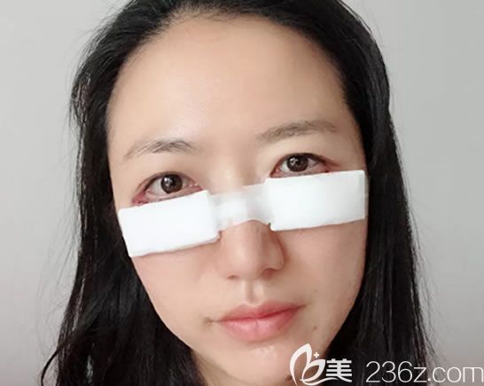 祛眼袋手術(shù)第2天眼部裹著紗布 祛眼袋手術(shù)第2天眼部裹著紗布