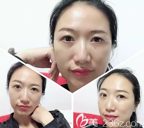 割眼袋第7天眼部淤青已經(jīng)消退 割眼袋第7天眼部淤青已經(jīng)消退