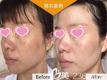 CP煥顏水光真人前后效果對(duì)比