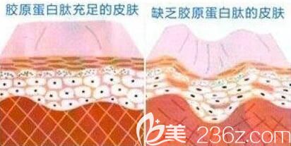 有膠原蛋白與沒(méi)有膠原蛋白皮膚的狀況