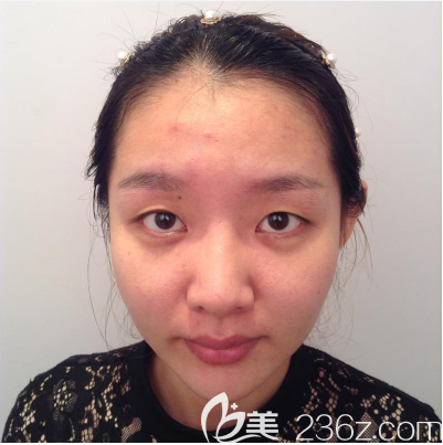 術(shù)前單眼皮照片 術(shù)前單眼皮照片