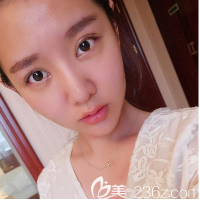 東莞華美雙眼皮案例7天拆線 東莞華美雙眼皮案例7天拆線