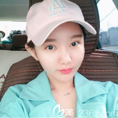 糾結(jié)了兩年終于在東莞華美找詹慧醫(yī)生給我做了全切雙眼皮