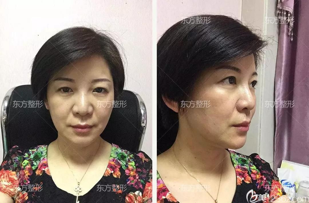 我在南寧東方整形做全臉<span style= 我在南寧東方整形做全臉<span style=