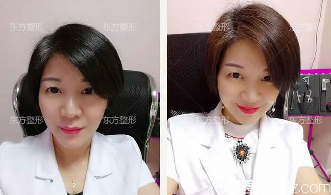 這是我在南寧東方整形做全臉線雕提升7天恢復(fù)圖，真實(shí)感受至少年輕10歲