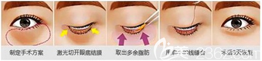 內(nèi)切法去眼袋手術(shù)示意圖 內(nèi)切法去眼袋手術(shù)示意圖