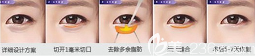 外切法去眼袋手術(shù)示意圖 外切法去眼袋手術(shù)示意圖