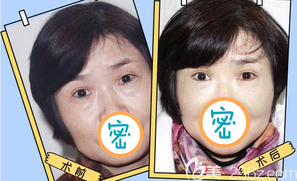 樂(lè)山達(dá)芬奇外切去眼袋前后對(duì)比圖 樂(lè)山達(dá)芬奇外切去眼袋前后對(duì)比圖