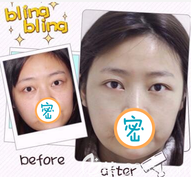 樂(lè)山達(dá)芬奇整形激光去眼袋案例 樂(lè)山達(dá)芬奇整形激光去眼袋案例