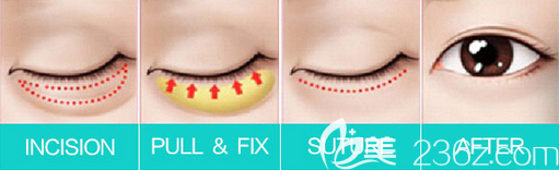 激光去眼袋手術(shù)示意圖 激光去眼袋手術(shù)示意圖