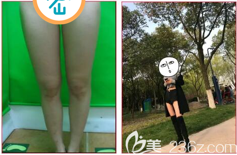 大腿吸脂前后對比效果