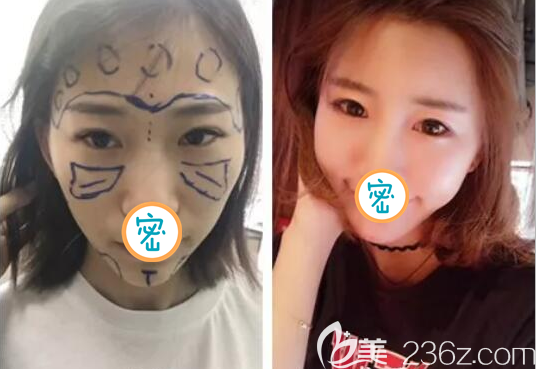 全面部脂肪填充術(shù)后效果圖