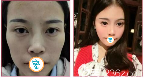 玻尿酸全面部精雕案例