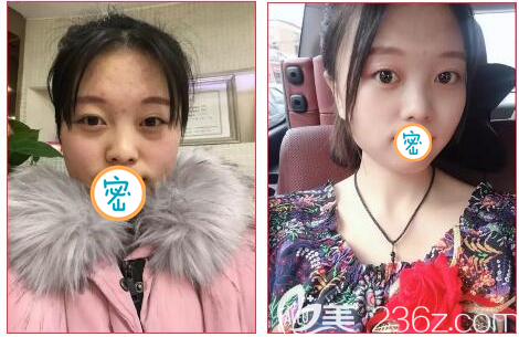 樂山達芬奇去眼袋案例