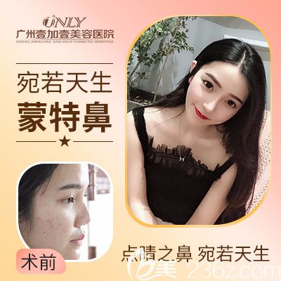 廣州壹加壹李明鼻綜合隆鼻案例 廣州壹加壹李明鼻綜合隆鼻案例