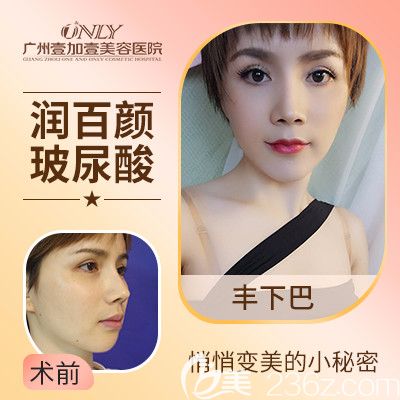 廣州壹加壹潤百顏玻尿酸豐下巴案例 廣州壹加壹潤百顏玻尿酸豐下巴案例