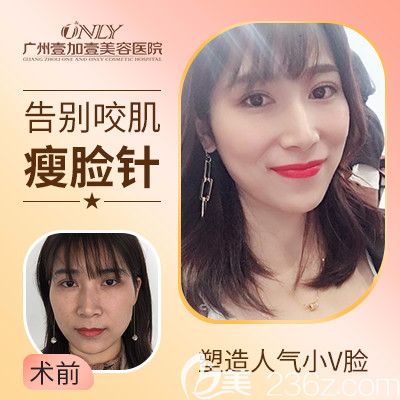 廣州壹加壹整形美容醫(yī)院瘦臉案例 廣州壹加壹整形美容醫(yī)院瘦臉案例