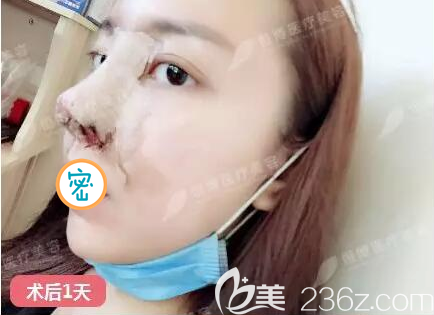 半肋鼻綜合術(shù)后即刻照片