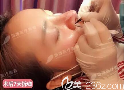 膨體+肋軟骨鼻綜合術(shù)后7天拆線