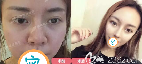 <!--<i data=20240703-sp></i>-->美容醫(yī)院半肋鼻綜合修復(fù)術(shù)前術(shù)后對比