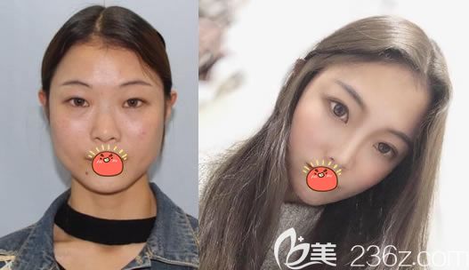 寧波薇琳李瑞做雙眼皮和隆鼻案例 寧波薇琳李瑞做雙眼皮和隆鼻案例