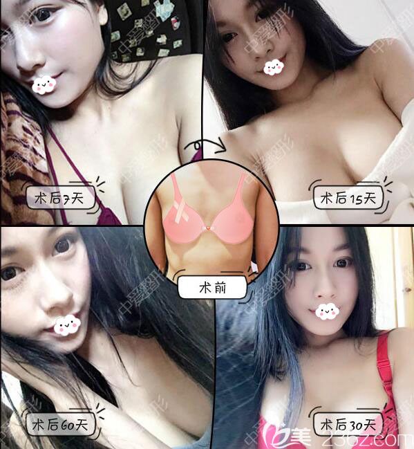 黃石中愛假體隆胸案例恢復過程圖