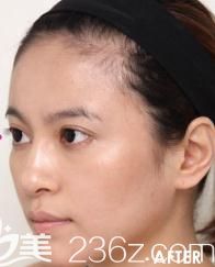 在衣理整形醫(yī)院找片桐衣理為我臉部注射玻尿酸，七天后年輕回少女臉