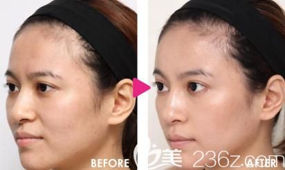 找片桐衣理為我臉部注射玻尿酸前后對(duì)比